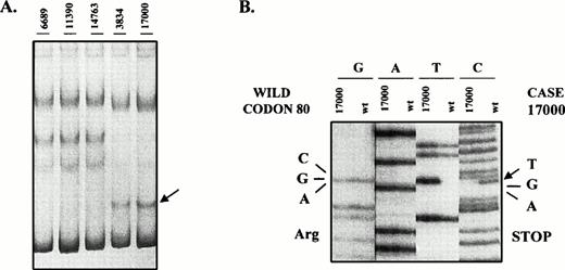 Fig. 2. SSCP analysis of p16INK4a exon 2. The abnormal mobility observed in two transformed FCLs (case 17000 and 3834) (A) is the result of the mutation in codon 80 with the change CGA (Arg) → TGA (Stop) (B). The western blot analysis of these two cases is shown in Fig 3.