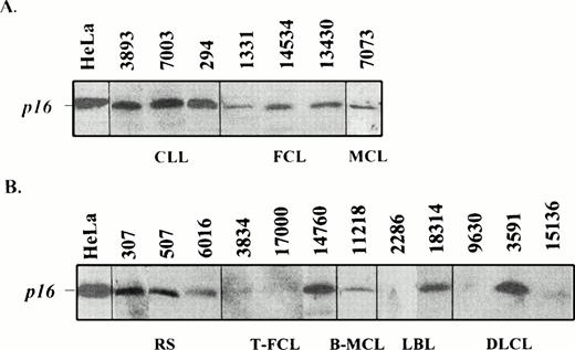 Fig. 3. Western blot analysis of p16INK4a in indolent (A) and aggressive (B) lymphomas. Two transformed FCLs (3834 and 1700), one LBL (2286), and two diffuse large B-cell lymphomas (9630 and 15136) show a loss of protein expression. The Southern blot analysis of cases 17000 (T-FCL), 2286 (LBL), 9630 (DLCL), and 15136 (DLCL) is shown in Fig 1. Tumors 2286 and 9630 showed a homozygous deletion of p16INK4a gene (Fig 1), whereas tumors 17000 and 15136 with germline configuration in the Southern blot analysis had a stop codon (Fig 2) and hypermethylation of the gene (Fig 4), respectively.