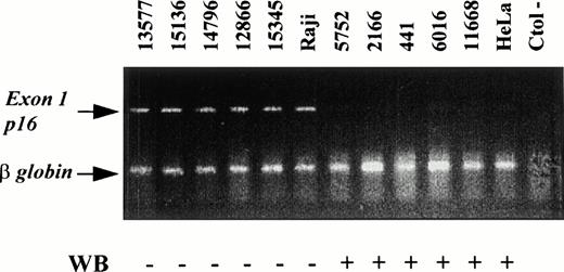 Fig. 4. Methylation status of the p16INK4a exon 1 in NHL analyzed by PCR and comparison with the results of the protein expression by Western blot analysis (WB). Products of p16INK4a exon 1 and the internal control β-globin are indicated. The amplification of exon 1 after digestion with SmaI indicates that this restriction site was methylated. Cases with p16INK4a exon 1 amplification showed loss of protein expression by Western blot whereas protein expression was detected in cases in which p16INK4a exon 1 was not amplified.