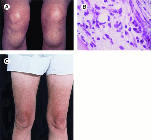 Unusual presentation of relapsed hairy cell leukemia. The patient is a 64-year-old man with hairy cell leukemia diagnosed in 1982 and had been in partial remission after treatment with splenectomy (1982), intermittent courses of α-interferon (1987-1994), and pentostatin (1994). In May 1996, he developed bilateral bony masses in the tibia, each about 6 cm in diameter (A), and a lump in the mucosa of the lower lip. He also had generalized lymphadenopathy, hepatomegaly of 5 cm, a hemoglobin level of 9.8 g/dL, a platelet count of 91 × 109/L, and a leukocyte count of 12 × 109/L with 70% hairy cells. Marrow trephine biopsy showed substantial replacement of normal hematopoietic tissue by hairy cells (B) and reticulin fibrosis. The buccal mucosal mass proved, on biopsy, to be a deposit of leukemic cells. Five weeks after a 7-day course of 2-chlorodeoxyadenosine, the tibial masses had resorbed (C). Repeat marrow biopsy 3 weeks later showed few hairy cells and a normal amount of reticulin. At follow-up 11 weeks after chemotherapy, the hematologic parameters were a hemoglobin level of 12.8 g/dL, a platelet count of 199 × 109/L, a white blood cell count of 6.5 × 109/L, a granulocyte count of 3.1 × 109/L, and a lymphocyte count of 2.9 × 109/L. There were no hairy cells in the peripheral blood film. (Courtesy of I.E. Okpala, MRCPath, FWACP, Central Sheffield University Hospitals, Royal Hallamshire Hospital, Glossop Road, Sheffield, UK, and J. Leslie, FRCPath, Norfolk & Norwich Hospital, Norwich, UK.) {/ANNT;;;left;0n}