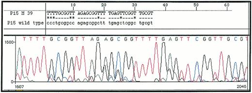 Fig. 1. DNA sequence of p15M PCR product from a patient with RAEB (upper sequence) as compared with Genbank sequence of p15INK4b gene (lower sequence). All cytosines are converted in thymidines except in methylated CpG dinucleotides.