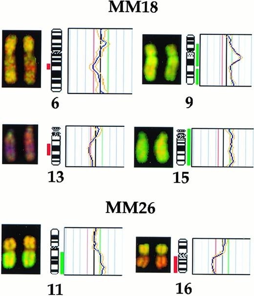 Fig. 2. Partial CGH karyotypes (left) and corresponding ratio profiles (right) observed in cases no. MM18 and MM26. Case no. MM18 showed deletions of chromosomes 6q21 and 13q14-22 and gains of 9q and chromosome 15. Case no. MM26 showed gain of 11q and loss of 16q. Hybridized tumor DNA was visualized via fluorescein isothiocyanate (green) and control DNA was visualized via Texas Red (red). The averaged green to red fluorescent signal ratio along the length of the chromosome is shown. The blue line in the ratio profile represents the mean of 8 to 10 chromosomes and the yellow line represents the standard deviation. The vertical red and green bars on the right of the ideogram indicate threshold values of 0.8 and 1.20 for loss and gain, respectively.