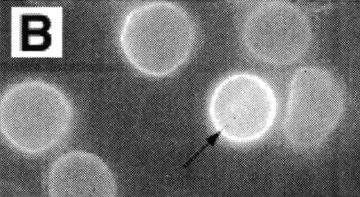 Fig. 3. Analysis of RBCs incubated with FITC-labeled AV after treatment with calcium in the presence of 4 μmol/L ionophore A23187 by fluorescence microscopy. (A) A representative field of this population as observed in bright field and (B) in fluorescence; note the RBC ghost indicated by arrow. (C) A calcium ionophore scrambled spherocytic red cell analyzed by serial optical sections in confocal fluorescent microscopy.