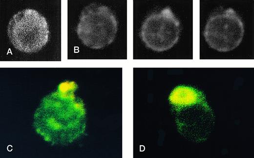 Fig. 4. RBCs from a thalassemic patient (HbE/β-thalassemia, splenectomized) enriched from the population labeled with AV-FITC using magnetic beads coated with an FITC antibody (see the Materials and Methods section). (A, B) Typical cells labeled with AV-FITC in the native unfixed state and then analyzed by serial optical sections in confocal fluorescent microscopy. Panel A shows the equatorial section of a cell homogeneously labeled with AV-FITC. Panel B shows three equatorial sections of a cell heterogeneously labeled with AV-FITC. (C,D) RBCs initially labeled with AV-FITC in the unfixed state and then labeled with monoclonal anti–α-globin chain antibody, and secondary Texas-Red–labeled goat antimurine antibody. This double-labeled cell was then analyzed by fluorescent microscopy. The areas where Texas Red (red) and FITC (green) overlap are yellow.