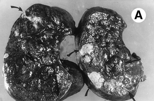 Fig. 2. (A) Photograph of the patient's spleen showing multiple nodules (arrows) with area of subcapsular infarcts (curved arrows). (B) Coronal STIR MR image of the (L) liver and spleen (IR 2450/100/30) shows multiple low signal intensities nodules (curved arrows) in the enlarged spleen. (C) Axial T1-weighted (SE 300/10) MR image shows splenomegaly with no focal splenic signal abnormality. (D) Axial T2-weighted (SE 4293/80) MR image of the spleen at the same level as (C) shows multiple low signal intensity nodules in the enlarged spleen (arrows).