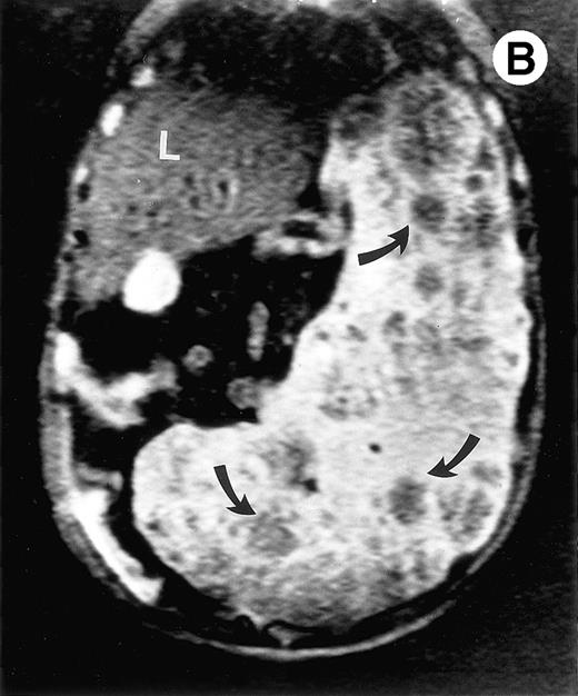 Fig. 2. (A) Photograph of the patient's spleen showing multiple nodules (arrows) with area of subcapsular infarcts (curved arrows). (B) Coronal STIR MR image of the (L) liver and spleen (IR 2450/100/30) shows multiple low signal intensities nodules (curved arrows) in the enlarged spleen. (C) Axial T1-weighted (SE 300/10) MR image shows splenomegaly with no focal splenic signal abnormality. (D) Axial T2-weighted (SE 4293/80) MR image of the spleen at the same level as (C) shows multiple low signal intensity nodules in the enlarged spleen (arrows).