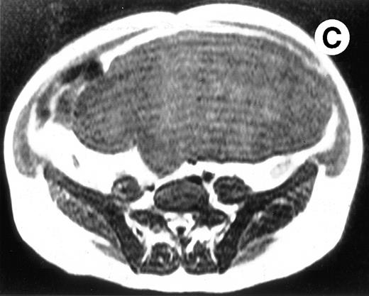 Fig. 2. (A) Photograph of the patient's spleen showing multiple nodules (arrows) with area of subcapsular infarcts (curved arrows). (B) Coronal STIR MR image of the (L) liver and spleen (IR 2450/100/30) shows multiple low signal intensities nodules (curved arrows) in the enlarged spleen. (C) Axial T1-weighted (SE 300/10) MR image shows splenomegaly with no focal splenic signal abnormality. (D) Axial T2-weighted (SE 4293/80) MR image of the spleen at the same level as (C) shows multiple low signal intensity nodules in the enlarged spleen (arrows).