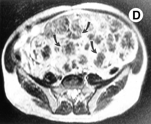 Fig. 2. (A) Photograph of the patient's spleen showing multiple nodules (arrows) with area of subcapsular infarcts (curved arrows). (B) Coronal STIR MR image of the (L) liver and spleen (IR 2450/100/30) shows multiple low signal intensities nodules (curved arrows) in the enlarged spleen. (C) Axial T1-weighted (SE 300/10) MR image shows splenomegaly with no focal splenic signal abnormality. (D) Axial T2-weighted (SE 4293/80) MR image of the spleen at the same level as (C) shows multiple low signal intensity nodules in the enlarged spleen (arrows).