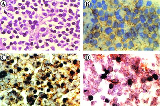 Fig. 2. Immunohistology of the retro-orbital centroblastic B-cell lymphoma arising in monkey 4. Sections were stained with hematoxylin-eosin (A) and immunostained with anti-CD20 MoAb (B). Immunohistochemical and in situ hybridization (brown) double-staining of CD20+ cells (yellow ring) (C) and of CD68+ cells (orange ring) (D) displaying intracellular SIV genome signals (dark brown).