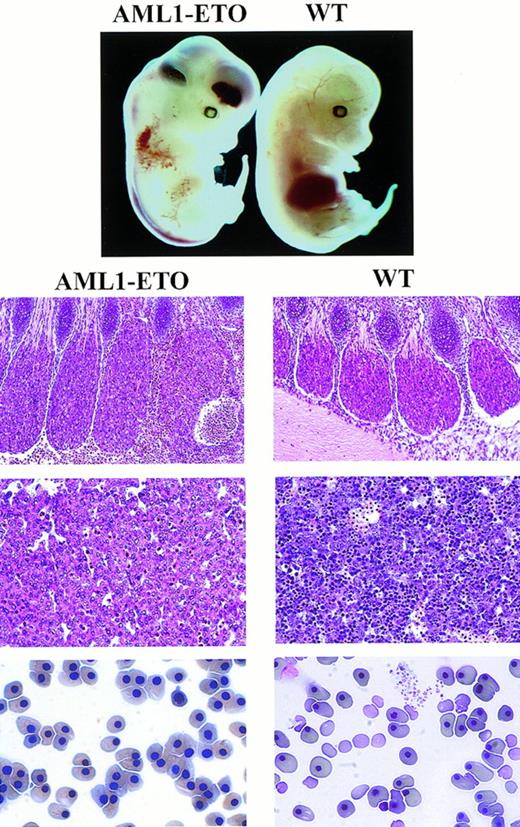 Fig. 2. Phenotype of E12.5 AML1-ETO/+ and wild-type (WT) embryos. (Top panels) AML1-ETO/+ embryos were identical in size to wild-type littermates, but were easily identifiable by the presence of fetal liver pallor and massive hemorrhages within the ventricles of the CNS and the soft tissues of the back. (Second panels) Sections showing hemorrhages within the dorsal root ganglia ofAML1-ETO/+ embryos. (Third panels) Sections of the fetal liver from AML1-ETO/+ embryos showing a complete absence of hematopoietic precursors with only rare primitive nucleated erythrocytes seen within hepatic sinusoids. By contrast, sections of the fetal liver from control littermates show numerous erythroblasts and scattered myeloblasts and megakaryocytes. (Bottom panels) Smears of peripheral blood show the absence of definitive erythrocytes and platelets in the AML1-ETO/+ embryos. By contrast, numerous enucleated definitive erythrocytes and platelets are seen in the peripheral blood from wild-type embryos.