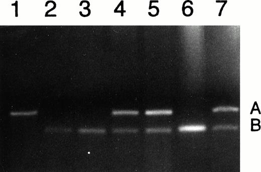 Fig. 1. Analysis of DNA from CML patients for heterozygosity of IGF2. Lane 1 shows patient homozygous for the A allele; lanes 2, 3, and 6 show patients homozygous for the B allele; and lanes 4, 5, and 7 show heterozygotes, with both A and B alleles.