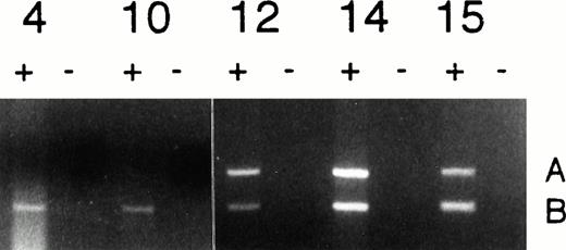Fig. 2. Analysis of Imprinting of IGF2 in CML. Normal monoallelic expression was seen in patients 4 and 10 (chronic phase), and biallelic expression was observed in patients 12 (accelerated phase), 14, and 15 (blast crisis). All reactions were performed in duplicate in the presence (+) and absence (−) of reverse transcriptase.