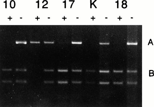 Fig. 3. Analysis of H19 promoter methylation in CML. Patients 10, 12, 17, 18, and cell line K562 (K) showed normal monoallelic methylation. Samples pretreated (+) or not pretreated (−) withHpaII, PCR amplified and then digested with Hha I, which detects the H19 polymorphism.