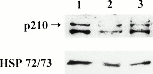 Fig. 3. Effect of BCR-ABL antisense ODN treatment on p210 levels in cells from patient no. 4. Lane 1, mononuclear cells incubated for 72 hours with culture medium without ODN (control); lane 2, mononuclear cells incubated for 72 hours with the J-sp B2A2antisense ODN; lane 3, mononuclear cells incubated for 72 hours with the J-nonsp B3A2 antisense ODN.