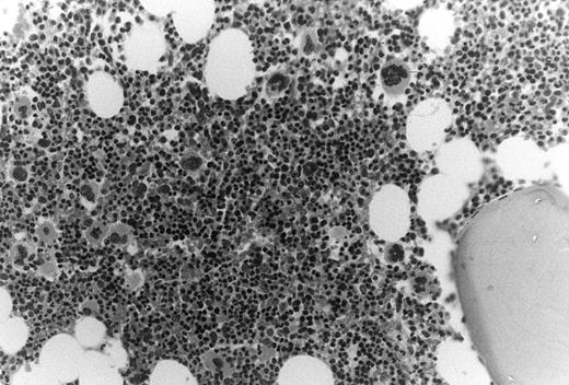 Fig. 2. Increased megakaryocytes in bone marrow biopsy samples obtained from HIV-infected patients with thrombocytopenia. In this cohort of thrombocytopenic HIV-infected patients bone marrow biopsy samples typically showed normal to abundant megakaryocytes; megakaryocyte/erythroid ratios were typically increased.