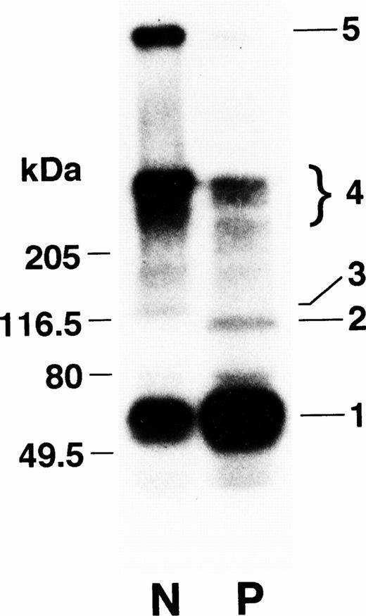 Fig. 5. Factor XIIIa–catalyzed cross-linking of α2-PI to the Marburg fibrin analyzed by autoradiography. Fibrinogen was clotted with thrombin and factor XIII in the presence of125I–α2-PI and CaCl2 at 37°C for 30 minutes. After extensive washing, the radiolabeled clots were subjected to SDS-PAGE followed by autoradiography. Band 1 represents α2-PI and bands 2 and 3 represent a 115-kD (Marburg α-chain–α2-PI) and a 135-kD (normal α-chain–α2-PI) complex, respectively. Bands 4 and 5 represent high-molecular-weight complexes.