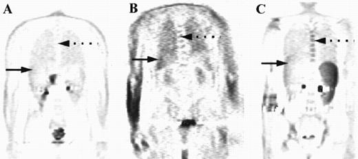 Fig. 1. Coronal images are shown from three patients with different degrees of marrow uptake on PET. FDG uptake within the marrow is seen on these sections in the thoracic spine (broken arrows) and within the liver (solid arrow). The intensity of uptake was graded as less than liver (A), equal to liver (B), or greater than liver (C), with the marrow deemed to be abnormal where uptake was equal to or greater than liver.