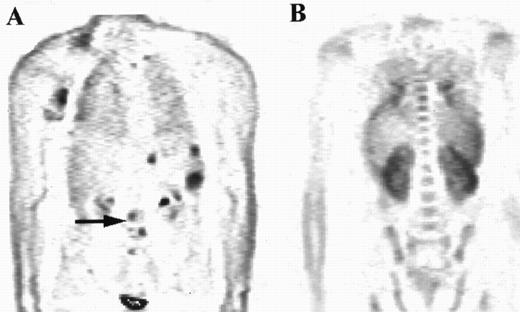 Fig. 2. The distribution of uptake within the marrow was noted. Focal abnormality is seen within the lumbar spine in patient A (arrow), while patient B has diffuse marrow abnormalities.