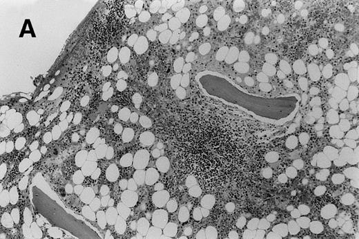 Fig. 3. Trephine biopsy sections. (A) A patient with follicular centroblastic centrocytic lymphoma stained with hematoxylin and eosin showing low-volume, nodular disease (original magnification ×100). (B) A patient with T-lymphoblastic lymphoma stained with anti-CD3; cells with dark cytoplasm are CD3+ (original magnification ×400). These photomicrographs show the low level of lymphoma infiltration which in both cases was detected by PET.