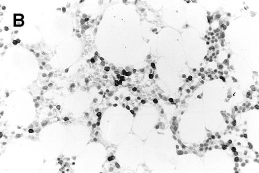 Fig. 3. Trephine biopsy sections. (A) A patient with follicular centroblastic centrocytic lymphoma stained with hematoxylin and eosin showing low-volume, nodular disease (original magnification ×100). (B) A patient with T-lymphoblastic lymphoma stained with anti-CD3; cells with dark cytoplasm are CD3+ (original magnification ×400). These photomicrographs show the low level of lymphoma infiltration which in both cases was detected by PET.