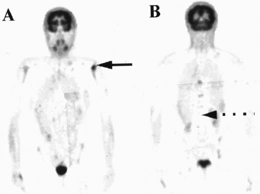 Fig. 4. PET images of a patient with areas of focal increased uptake in marrow, most notably in the left humerus (solid arrow, A) and in the thoracic spine (B). The marrow was not diffusely abnormal and much of the axial skeleton exhibited FDG uptake less than in liver (broken arrow).