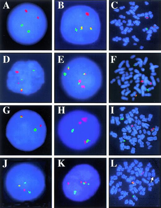 Fig. 1. Representative D-FISH patterns in interphase nuclei and metaphase cells. (A) Normal, 2R2G. (B) One copy of t(9;22)(q34;q11.2), 1R1G2F. (C) t(9;22)(q34;q11.2), 1R1G2F. (D) One copy of t(9;22)(q34;q11.2), 2R2G1F caused by a split BCR and ABL signal on abnormal chromosome 9. (E) One copy of t(9;22)(q34;q11.2) and an additional Ph chromosome, 1R1G3F. (F) t(9;2210)(q34;q11.2;q22), 2R2G1F. (G) Atypical pattern 1R1G1F, t(9;22)(q34;q11.2). (H) Atypical pattern 2R1G1F, t(9;22)(q34;q11.2). (I) 1R2G1F, metaphase with a masked Ph chromosome caused by insertion translocation of ABL into BCR. (J) Atypical pattern 1R2G1F, t(9;22)(q34;q11.2). (K) Nucleus with a false-positive pattern due to signal separation and coincidental overlap of BCR and ABL signals. (L) 1R1G1F, metaphase with no BCR or ABL on the abnormal chromosome 9 (arrow).