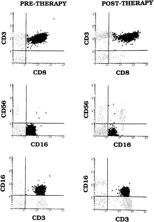 Fig. 1. T-LGL cells (CD3+CD8+CD16+CD56−) shown by multiparameter flow cytometry in Patient 5's peripheral blood before and after CSA therapy. The cells also expressed CD57 (not shown).