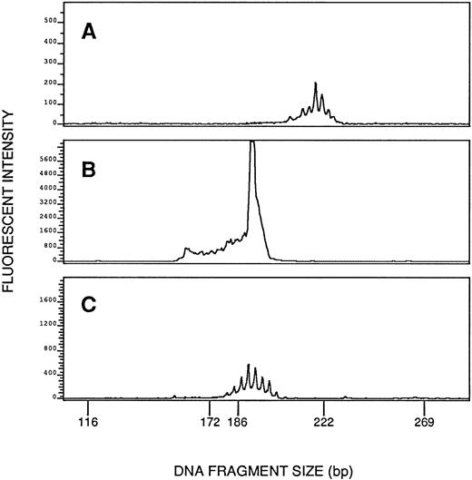 Fig. 3. Clonal rearrangement of TCR-Vβ4 shown by the PCR in Patient 5's blood cells after cyclosporine therapy (B). Shown as negative controls are Patient 5's blood cells studied with Vβ1 primers (A) and blood cells from a normal donor studied with Vβ4 primers (C). The image in (A) is magnified 60-fold in relation to the images in (B) and (C). (A) and (C) show multiple small peaks produced by polyclonal rearrangements, whereas (B) shows a discrete tall peak produced by a clonal rearrangement and superimposed on a polyclonal background.