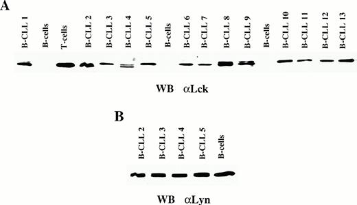 Fig. 1. Expression of Lck in B-CLL. (A) Immunoblot analysis using an anti-Lck MoAb of peripheral blood B-cell lysates from healthy controls and from representative B-CLL patients. A lysate from normal T cells is included as a positive control. (B) Immunoblot analysis using an anti-Lyn MoAb of peripheral blood B-cell lysates from a healthy control and from representative B-CLL patients.
