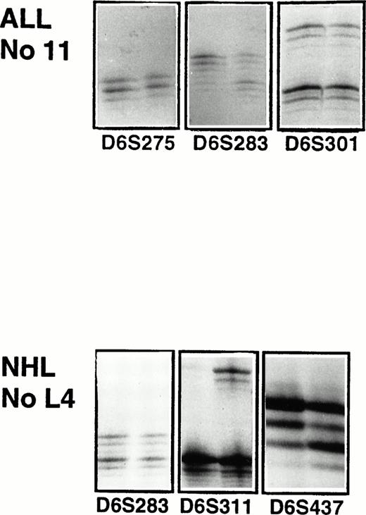 Fig. 4. Microsatellite analysis of patient 11 with ALL and patient L4 with high-grade T-cell NHL. For each microsatellite marker the PCR products of the malignant sample is shown to the left and of the normal sample to the right. For ALL patient 11, there is LOH in marker D6S283. Patient L4 has a LOH in marker D6S311 and D6S437.