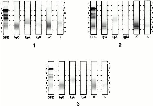 Fig. 1. Oligoclonal bands by IFE. Gel 1 shows an IgA λ monoclonal band that resolved with pretransplant chemotherapy. Four months after Mel200 transplant, the patient's serum had IgG κ oligoclonal bands (gel 2), which resolved after the second transplant (gel 3).