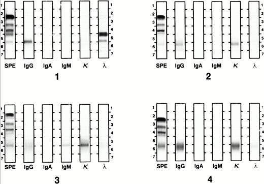 Fig. 2. Apparent IS by IFE. Gel 1 shows a IgG λ monoclonal protein with free λ light chain. The IgG λ monoclonal protein band resolved with pretransplant chemotherapy and a single IgG κ band appeared (gel 2). After the second transplant, the IgG pattern was polyclonal and a new IgM κ monoclonal band appeared (gel 3). This band was replaced by a polyclonal IgG pattern 1 month later (gel 4).