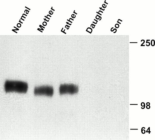 Fig. 3. Western blot analysis of GPIbα in platelet lysate. Platelet lysate from a normal volunteer, the parents, and the two affected children was analyzed by immunoblotting with the GPIbα-specific monoclonal antibody 142.6. GPIbα is readily detectable in the normal volunteer and in both parents, but not in the children.