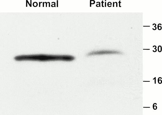 Fig. 4. Western blot analysis of GPIbβ in platelet lysate. Platelet lysate from a normal individual and the affected brother was analyzed by immunoblotting with an anti-GPIbβ polyclonal antibody. A total of 11 μg and 168 μg of protein was loaded on the gel from the normal individual and patient respectively. GPIbβ is readily detectable in the normal control but is significantly reduced in the patient.