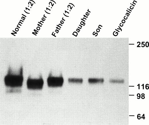 Fig. 5. Western blot analysis of plasma GPIbα. Platelet-poor plasma was immunoprecipitated with 142.2, analyzed by SDS-PAGE on an 8% to 16% exponential gradient in the presence of β-mercaptoethanol, and immunoblotted with MBC 142.6. Plasma samples from the parents and the normal volunteer were diluted 1:2. Each patient's plasma contains a soluble GPIbα, similar to glycocalicin, although there is significantly less in the two patients as compared with the parents and normal sample.
