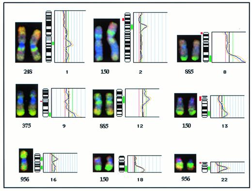 Fig. 2. Partial CGH karyotypes (left) and corresponding ratio profiles (right) illustrating high level amplification of chromosomal regions in DLBL tumors studied. Hybridized tumor DNA was visualized via FITC (green) and control DNA via Texas Red (red). The averaged green to red fluorescent signal ratio along the length of the chromosome is shown. The blue line in the ratio profile represents the mean of eight to 10 chromosomes and the yellow line represents the standard deviation. The vertical red and green bars on the right of the ideogram indicate threshold values of 0.80 and 1.20 for loss and gain, respectively.