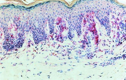Fig. 7. Detection of IL-15 in early CTCL lesion (patch stage) by an IL-15 antibody. The binding of the specific antibody to IL-15 was detected by an alkaline phosphatase (AP) coupled second antibody directed against the Fc region of the IL-15 antibody. Binding of the IL-15 antibody after APAAP staining was strongest in the junction zone between epidermis and dermis where CTCL cells show their highest densities. The specificity of the binding of the IL-15 antibody was tested by a competition experiment with recombinant IL-15 (not shown).