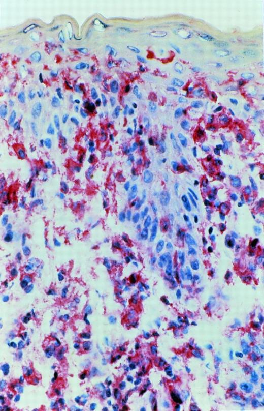 Fig. 8. A more advanced CTCL lesion (plaque stage): immunoreactivity for IL-15 after APAAP staining was detected in the junctional area and in deeper parts of the dermis heavily infiltrated by mononuclear cells.