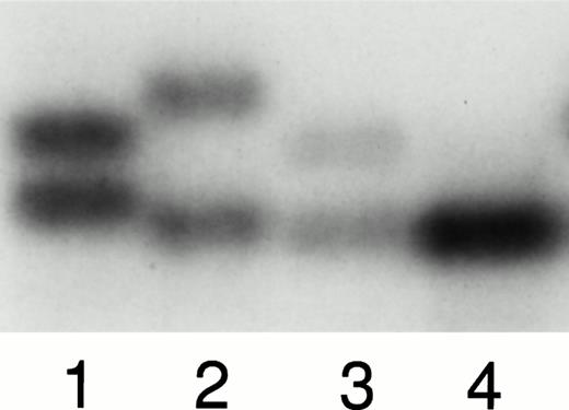 Fig. 1. (A). Analysis of bone marrow and EBV cell-line DNA from patient 6 and DNA extracted from the blood of his parents. Lanes 1 through 4 were analyzed using the polymorphic nucleotide repeat described by Andersen et al.36 Lane 1 shows maternal DNA, lane 2 shows paternal DNA, lane 3 shows EBV-line DNA, and lane 4 shows DNA extracted from leukemic bone marrow. The patient's EBV line, which is not involved in the leukemic clone, retains both parentalNF1 alleles, whereas the affected bone marrow sample shows a single allele consistent with LOH at NF1 in this leukemia. (B). Results of the IVTT assay in patient 6. Lanes 1 to 4 show polypeptides synthesized from RT-PCR product corresponding to exons 28 through 38 of the NF1 coding sequence. The sample in lane 1 is derived from patient 6; samples in lanes 2 through 4 show a normal protein pattern. The full-length polypeptide is indicated by an arrow. The truncated protein in lane 1, marked by an asterisk, represents the 6579 + 18 G to A mutation seen in the splice consensus sequence flanking exon 34 ofNF1 in this patient. The full-length IVTT polypeptide in this patient is represented by a fainter band than is seen in lanes 2 to 4, consistent with loss of the normal NF1 allele in this leukemia.