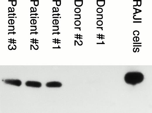 Fig. 4. PCR analysis of EBV genome in neutrophils from IM patients. PCR amplification was performed with DNA isolated from neutrophils obtained from EBV patients and from healthy EBV-seropositive donors (negative control). Amplification was performed using BamHI W primers as described in Materials and Methods. DNA extracted from Raji cells was used as positive control.