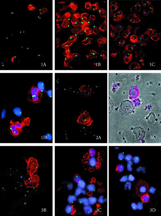 Fig. 1. Original magnification × 420. Antigen-positive cells appear in red. In Figs 1D, 3C, and 3D, nuclei are counterstained in blue (DAPI; Oncor). Chromosome-specific hybridization signals are seen as green dots in simple and as green and blue dots in double hybridization experiments. (A) Mixed lymphoid chimerism in patient no. 2. Two CD3+ cells are XX, one is XY. CD3− cells are XY in relapse. X, green dot; Y, blue dot. (B) Male CD15+ cells at relapse in patient no. 2. X, green dot. (C) One female CD15+ cell (XX) within male CD15+ cells (XY) at week 6 after DLI in patient no. 2. X, green dot; Y, blue dot. (D) CD15+ and CD15−cells are all XX at week 17 after DLI in patient no. 2. X, green dot.