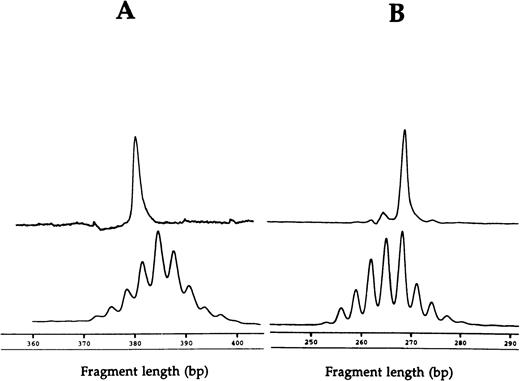 Fig. 1. CDR3 fragment analysis of (A) TCR AV 12S1 CD4 T-cell expansion (49%) with AV 12S1 CD4 control and of (B) BV3 CD8 expansion (33%) with BV3 CD8 control of patient 1.