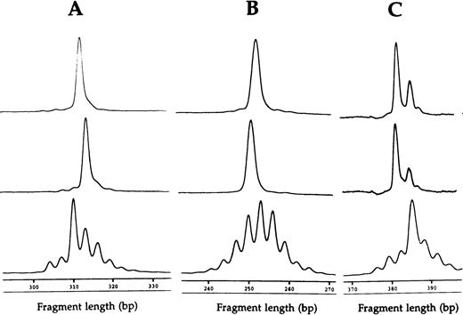 Fig. 2. CDR3 fragment analysis of T-cell expansions at separate time points, showing (A) BV8 CD4 T-cell expansions of patient three 10 months apart (15% and 29%) and (B) BV2 CD4 T-cell expansions of patient four 4 months apart (50% and 60%), and (C) AV12S1 CD8 T-cell expansion of patient five 2 months apart (41% and 35%). Relevant controls of healthy subjects are shown at the bottom.