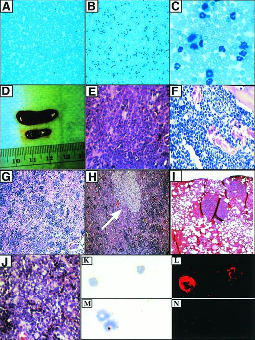 Fig. 3. Characteristics of the P210-induced myeloproliferative disease. (A) Peripheral blood from a mouse transduced with a control retrovirus (MigR1). Original magnification × 100. (B) Typical appearance of peripheral blood from mouse with myeloproliferative disease. Original magnification × 100. (C) Higher power view of (B). Original magnification × 1,000. (D) Splenomegaly associated with myeloproliferative disease. The diseased spleen is on top and the spleen from a MigR1 control animal is below. (E) Hematoxylin and eosin (H&E) section of spleen from (D). The red pulp is replaced by sheets of granulocytes. Original magnification × 400. (F) Hypercellular murine CML bone marrow. The great majority of cells are mature granulocytes. Original magnification × 400. (G) Liver in murine CML shows infiltration of mature myeloid cells and EMH in sinusoids. Original magnification × 100. This mouse did not have the macrophage expansion. (H) Murine CML liver with macrophage expansion (arrow). Note infiltrating hematopoietic cells in sinusoids. Original magnification × 400. (I) Pulmonary infiltrates of EMH in P210 mice. Original magnification × 100. (J) T-cell lymphoma associated with blast transformation (from an abdominal mass). Original magnification × 400. This tumor developed after 2 rounds of serial transplant of the myeloproliferative disease from mouse H2. (K) Wright-Giemsa staining of cells from peripheral blood of mouse receiving Mig210-transduced bone marrow cells. Original magnification × 400. (L) Abl expression in the cells from (K) as detected by the abl monoclonal antibody 24-11. Original magnification × 400. (M) Wright-Giemsa staining of cells from peripheral blood of mouse receiving Mig210-transduced bone marrow cells. Original magnification × 400. (N) Staining with an isotype control. Original magnification × 400.