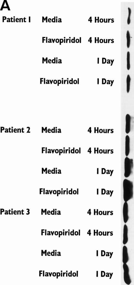 Fig. 4. (A) Expression of bcl-2 protein in human CLL cells at 4 and 24 hours after incubation with medium or 0.18 μmol/L of flavopiridol. The cells were obtained from CLL patients after obtaining informed consent, isolated, and cultured at 5 × 106/mL in medium or flavopiridol (0.18 μmol/L). Cell lysates were prepared and protein concentration was quantified using the BCA method (Pierce). Two micrograms of protein/lane from the CLL cell lysates was loaded onto a 10% sodium dodecyl sulfate-polyacrylamide gel electrophoresis (SDS-PAGE) gel and electrophoresed. Bcl-2 protein was detected using an anti–bcl-2 monoclonal antibody (Dako). Lane equivalent loading was certified by assessment with Fast Green Staining (not shown). (B) Expression of p27 protein in human CLL cells at 4 and 24 hours after incubation with medium or 0.18 and 0.33 μmol/L of flavopiridol. The cells were obtained from CLL patients after obtaining informed consent, isolated, and cultured at 5 × 106/mL in medium or flavopiridol (0.18 or 0.33 μmol/L). Cell lysates were prepared and protein concentration was quantified using the BCA method (Pierce). Five micrograms of protein/lane from the CLL cell lysates was loaded on a 10% SDS-PAGE gel and electrophoresed. The p27 protein was detected using an anti-p27 polyclonal antibody (Oncogene). Lane equivalent loading was certified by assessment with Fast Green Staining (not shown).