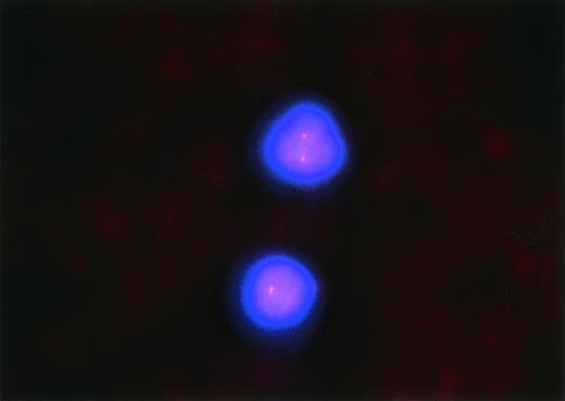 Fig. 9. Fluorescence in situ hybridization detection of the monoallelic deletion of 17p13.1 in patient 28a. Two lymphocytes from this patient’s blood smear are shown, each with only one detectable signal for 17p13.1. This same pattern was observed in 35% of the blood leukocytes and constituted the diagnosis of monoallelic deletion of 17p13.1 (original magnification × 1,000).