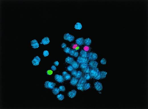 Fig. 2. FISH analysis of BLIN-2 cells from February 1998. Normal chromosome 9 is shown in red, normal chromosome 20 in green, and dic(9;20) as red/green. Chromosomes were counterstained with DAPI (blue).