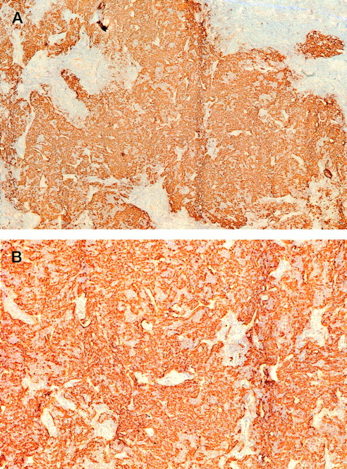 Fig. 1. Tissue section of lymphoma no. 5 stained for FDCs with antibodies against CD21L (DRC-1). Magnification (A) × 50 and (B) × 125.