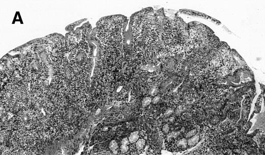 Fig. 1. (A) Case no. 1. (B and C) Case no. 2. (D) Case no. 3. (E) Case no. 4. (A, B, D, and E) Duodenal biopsies showing total villous atrophy with crypt hyperplasia and infiltration of lamina propria by nonatypical inflammatory cells (Hematoxylinandeosin; original magnification × 10). (C) Jejunal biopsy showing villous atrophy and ulcerations with regenerative epithelial changes on the border of ulcerations; no evidence of lymphoma.