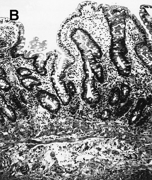 Fig. 1. (A) Case no. 1. (B and C) Case no. 2. (D) Case no. 3. (E) Case no. 4. (A, B, D, and E) Duodenal biopsies showing total villous atrophy with crypt hyperplasia and infiltration of lamina propria by nonatypical inflammatory cells (Hematoxylinandeosin; original magnification × 10). (C) Jejunal biopsy showing villous atrophy and ulcerations with regenerative epithelial changes on the border of ulcerations; no evidence of lymphoma.